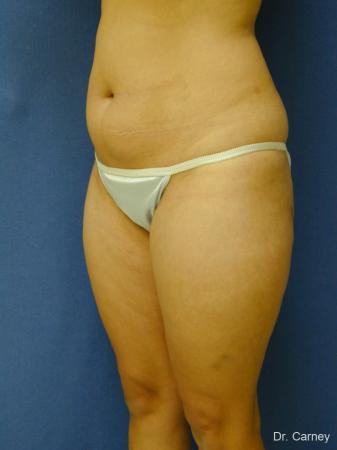 Virginia Beach Liposuction 1284 - Before Image 2