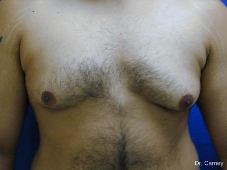 Virginia Beach Gynecomastia 1255 - Before Image 4