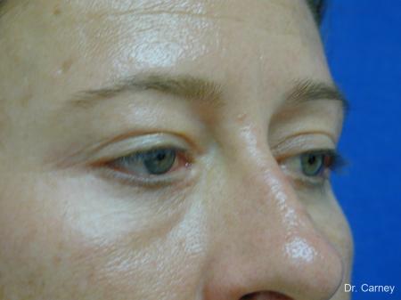 Virginia Beach Eyelid Lift 1209 - After Image 2