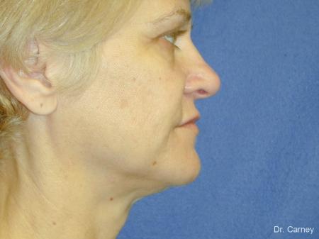 Virginia Beach Facelift 1346 - Before and After Image 5