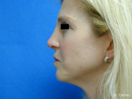 Virginia Beach Rhinoplasty 1343 - After Image 5