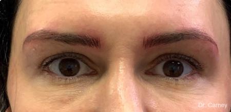 Microblading: Patient 1 - After Image 1