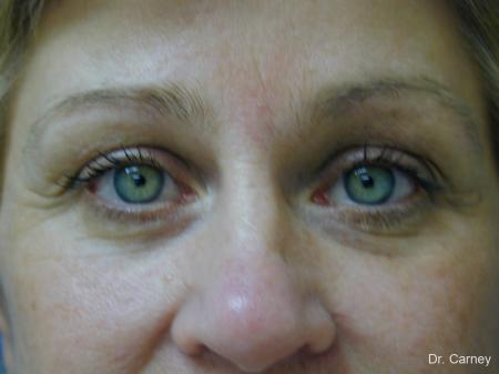 Virginia Beach Eyelid Lift 1344 - After Image 2