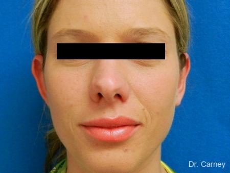 Virginia Beach Otoplasty Earlobe Repair 1223 - After Image 3