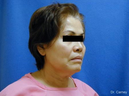 Virginia Beach Neck Lift 1268 - Before Image 2