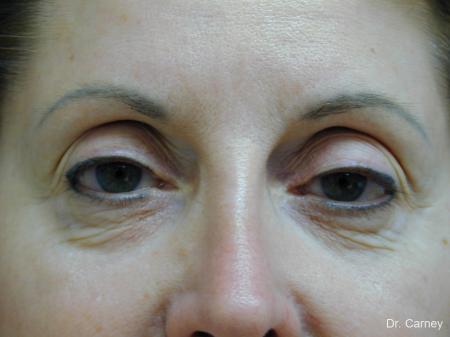 Virginia Beach Eyelid Lift 1131 - Before Image 1