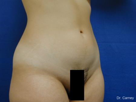 Virginia Beach Liposuction 1276 - Before Image 2