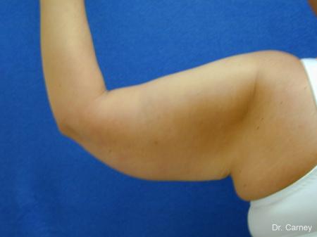 Virginia Beach Brachioplasty 1140 - After Image 3