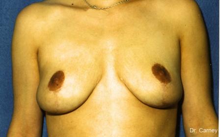 Virginia Beach Breast Lift 1191 - After Image 1