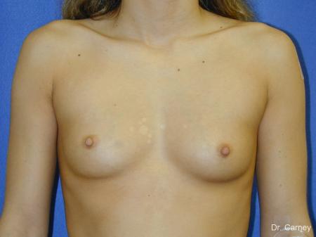 Virginia Beach Breast Augmentation 1097 - Before and After Image 3