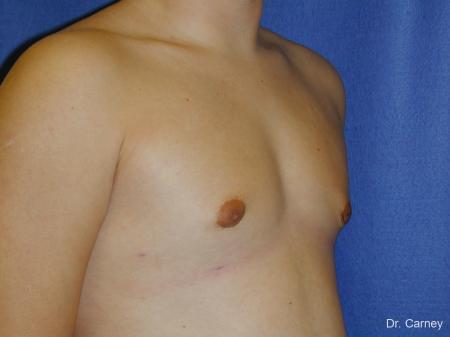 Virginia Beach Gynecomastia - After Image 2