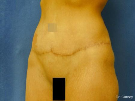 Tummy Tuck: Patient 1 - After Image 2