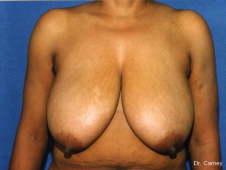 Virginia Beach Breast Reduction 1228. - Before Image 1