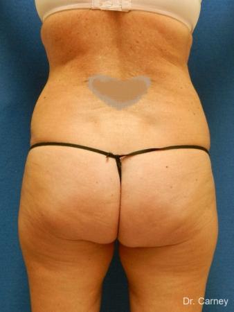 Virginia Beach Liposuction 1279 - After Image 4