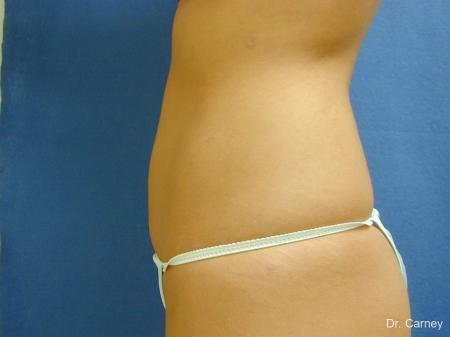 Virginia Beach Liposuction 1277 - After Image 5