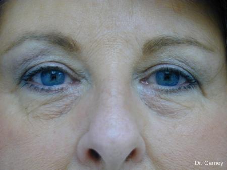 Virginia Beach Eyelid Lift 1129 - After Image 1