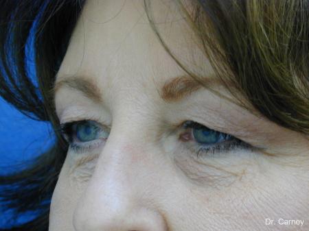 Virginia Beach Eyelid Lift 1129 - Before and After Image 3
