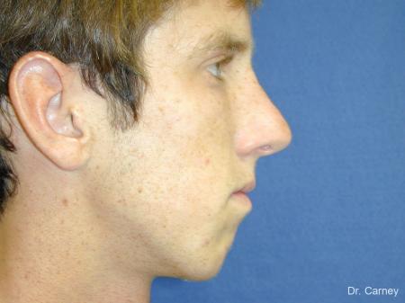 Virginia Beach Rhinoplasty 1219 - After Image 1