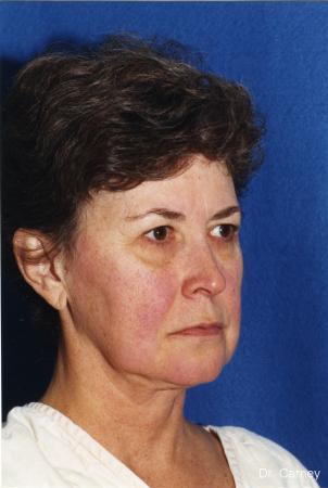 Virginia Beach Facelift 1134 - Before Image 1