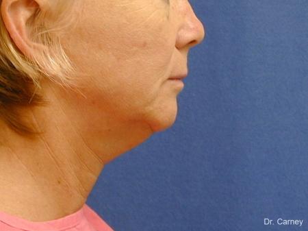 Virginia Beach Neck Lift 1264 - Before and After Image 2