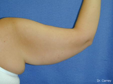 Virginia Beach Brachioplasty 1140 - After Image 2