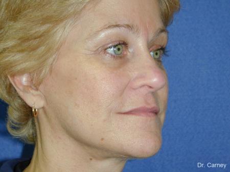 Virginia Beach Brow Lift 1345 - After Image 1