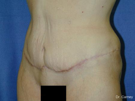 Virginia Beach Tummy Tuck 1249 - After Image 1
