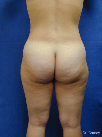 Virginia Beach Liposuction 1285 - Before and After Image 5