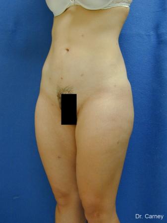 Virginia Beach Liposuction 1285 - After Image 3