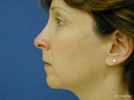 Virginia Beach Brow Lift 1217 - Before Image 3