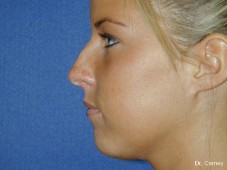 Virginia Beach Rhinoplasty 1218 - Before Image 3