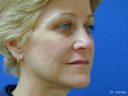 Virginia Beach Facelift 1346 - After Image 2