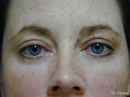 Virginia Beach Eyelid Lift 1138 - After Image 1