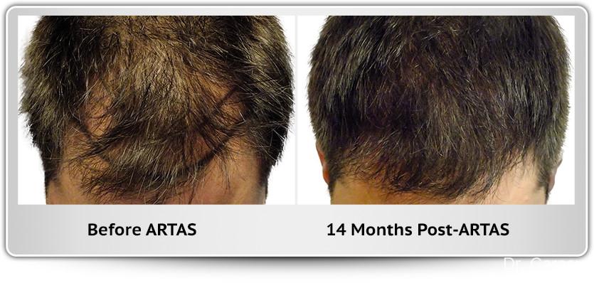 Hair Transplantation: Patient 1 - Before and After 1