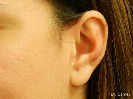 Virginia Beach Otoplasty Earlobe Repair 1225 - After Image 2