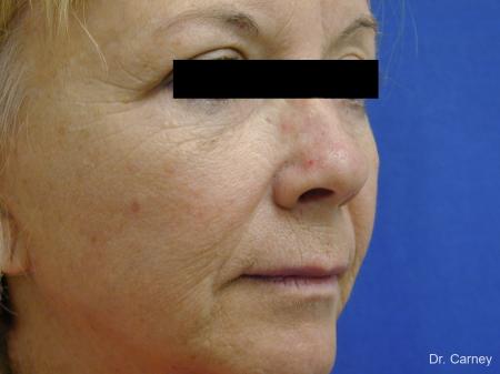 Virginia Beach Brow Lift 1266 - Before Image 1