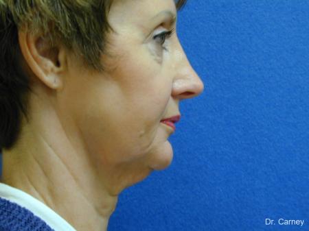 Virginia Beach Facelift 1132 - Before and After Image 3