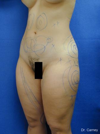 Virginia Beach Liposuction 1285 - Before Image 3