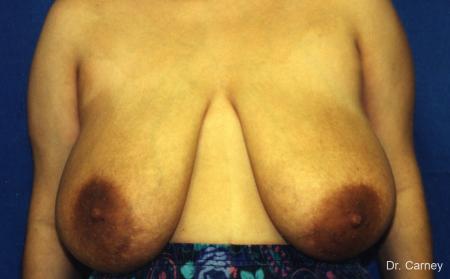 Virginia Beach Breast Lift 1191 - Before Image 1