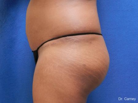 Abdominoplasty: Patient 1 - After Image 5
