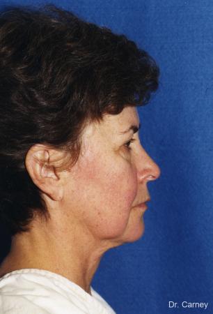 Virginia Beach Facelift 1134 - Before Image 2