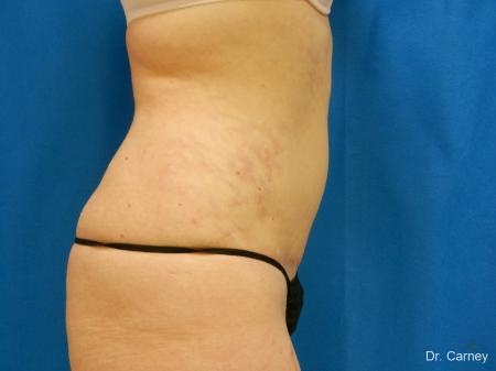 Virginia Beach Tummy Tuck 1251 - After Image 3
