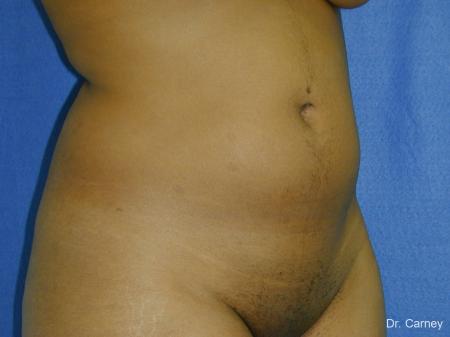 Virginia Beach Liposuction 1283 - Before Image 1