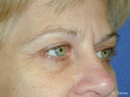 Virginia Beach Eyelid Lift 1344 - Before Image 4