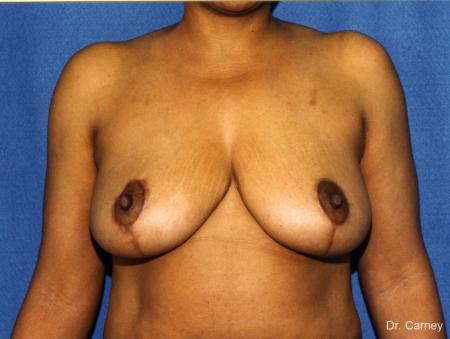 Virginia Beach Breast Reduction 1228. - After Image 1
