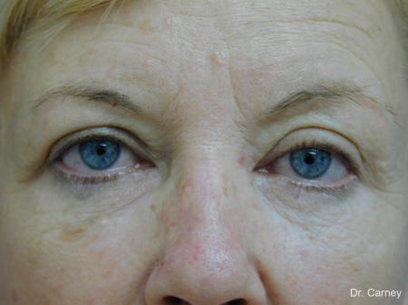 Virginia Beach Brow Lift 1266 - Before Image 3
