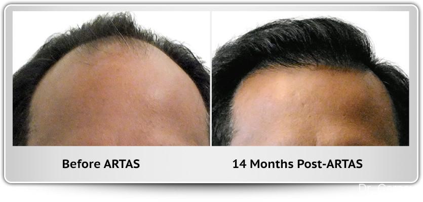 Hair Transplantation: Patient 11 - Before and After 1