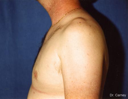 Virginia Beach Gynecomastia 1227 - After Image 2