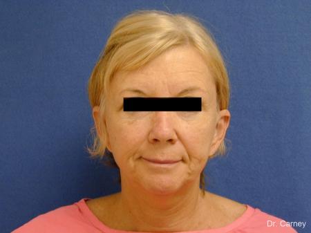 Virginia Beach Facelift 1262 - Before Image 1