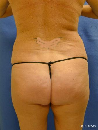 Virginia Beach Liposuction 1279 - Before Image 4